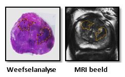 Weefselanalyse en MRI beeld met tumoren aangeduid in geel
