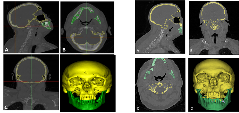 2 Vergelijking segmentatie links betalende software Materialise; rechts gratis software 3D-slicer A) Sagitaal zicht CT-scan. B) Axiaal zicht CT-scan. C) Coronaal zicht CT-scan. D) 3D projectie vanuit CT