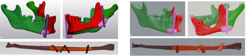 vergelijking design links betalende software Materialise®; rechts gratis software blender