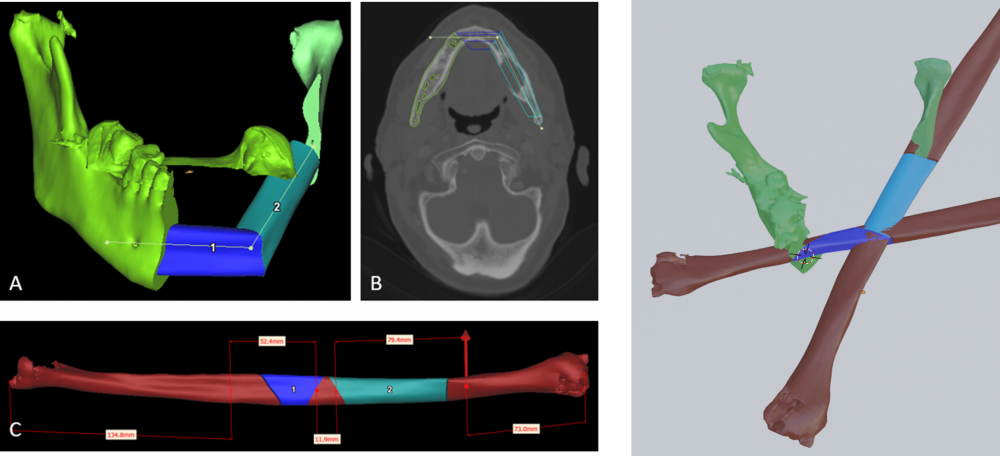 Vergelijking virtuele planning links betalende software Materialise®; rechts gratis software Blender A: 3D reconstructie; B: reconstructie op CT; C: onderdelen verwijdert uit kuitbeen; D: 3D reconstructie blender