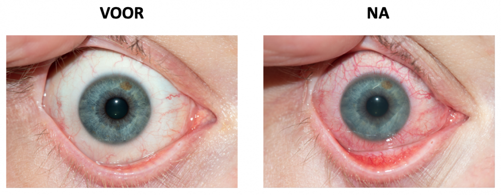 Weergave van het oog zonder zwembril