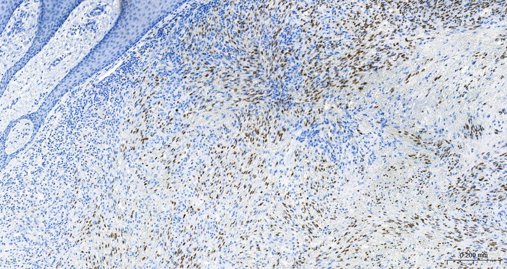 Figuur 1. Microscopisch beeld van de IHC-kleuring voor HHV8 op een huidexcisie van de enkel met Kaposi sarcoma. Beelden gescand met Pannoramic-250 (3DHISTECH) op vergroting 10X en Schaal 0,200mm.