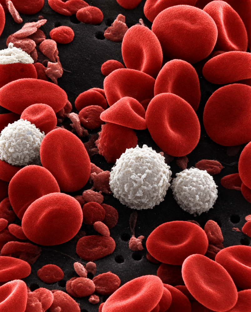 Rode en witte bloedcellen onder de microscoop. Kanker in de witte bloedcellen wordt leukemie genoemd.
