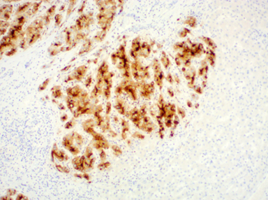 Hepatocellulair carcinoom gekleurd met Glypican-3 (Bron: Lieselot Liekens)