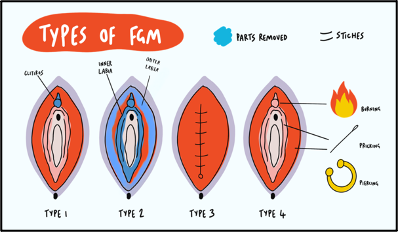 Types of FGM