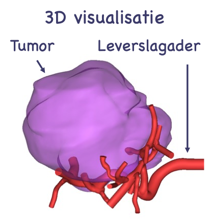 3D visualisatie digitale tumor en leverslagaders
