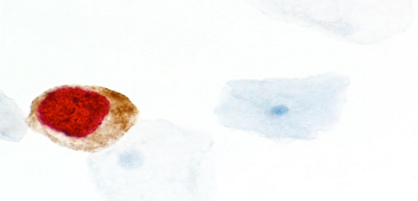 Figuur 1 : CINtec PLUS-positieve cel. In deze cel is p16 bruin gekleurd in het cytoplasma en Ki-67 rood in de kern, wat wijst op co-expressie van beide eiwitten in dezelfde cel.